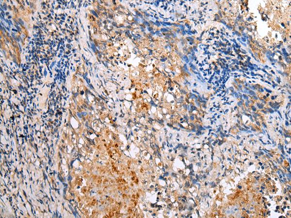 BAG2 Antibody - Immunohistochemistry of paraffin-embedded Human lung cancer tissue  using BAG2 Polyclonal Antibody at dilution of 1:25(×200)