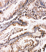 BAG3 / BAG-3 Antibody - BAG3 / BAG-3 antibody. IHC(P): Human Intestinal Cancer Tissue.
