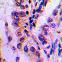 BAG3 / BAG-3 Antibody - Immunohistochemical analysis of BAG3 staining in human lung cancer formalin fixed paraffin embedded tissue section. The section was pre-treated using heat mediated antigen retrieval with sodium citrate buffer (pH 6.0). The section was then incubated with the antibody at room temperature and detected with HRP and DAB as chromogen. The section was then counterstained with hematoxylin and mounted with DPX.