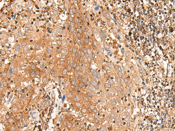 BAG3 / BAG-3 Antibody - Immunohistochemistry of paraffin-embedded Human cervical cancer tissue  using BAG3 Polyclonal Antibody at dilution of 1:35(×200)