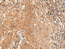BAG3 / BAG-3 Antibody - Immunohistochemistry of paraffin-embedded Human cervical cancer tissue  using BAG3 Polyclonal Antibody at dilution of 1:35(×200)