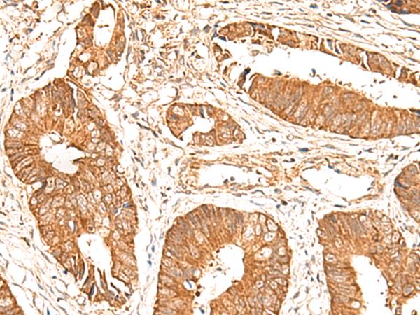 BAG3 / BAG-3 Antibody - Immunohistochemistry of paraffin-embedded Human colorectal cancer tissue  using BAG3 Polyclonal Antibody at dilution of 1:35(×200)