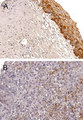 BAG5 Antibody - Formalin-fixed, paraffin-embedded human cervical tissue stained for BAG-5 expression using Polyclonal Antibody to BAG-5 at 1:2000. A. normal cervix epithelium. B. cervical cancer. Hematoxylin-Eosin counterstain.