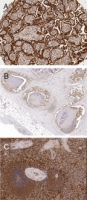 BAG5 Antibody - Formalin-fixed, paraffin-embedded human tissues stained for BAG-5 expression using Polyclonal Antibody to BAG-5 at 1:2000. A. normal placenta. B. breast cancer. C. normal spleen. normal cervix epithelium. Hematoxylin-Eos in counterstain.