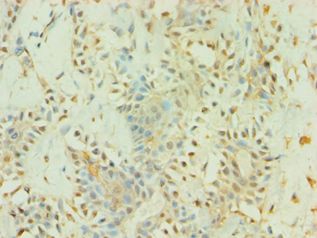 BAG5 Antibody - Immunohistochemistry of paraffin-embedded human breast cancer using antibody at 1:100 dilution.