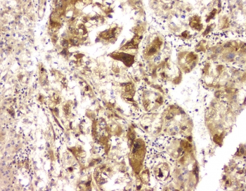 BAG6 / G3 / Scythe Antibody - IHC staining of FFPE human liver cancer with BAG6 antibody at 1ug/ml. HIER: boil tissue sections in pH6, 10mM citrate buffer, for 10-20 min and allow to cool before testing.