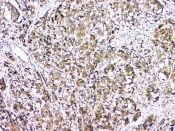 BAG6 / G3 / Scythe Antibody - IHC staining of FFPE human stomach cancer with BAG6 antibody at 1ug/ml. HIER: boil tissue sections in pH6, 10mM citrate buffer, for 10-20 min and allow to cool before testing.