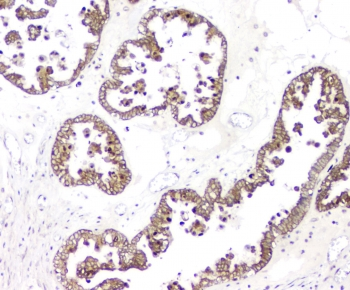 BAG6 / G3 / Scythe Antibody - IHC staining of FFPE human ovarian cancer with BAG6 antibody at 1ug/ml. HIER: boil tissue sections in pH6, 10mM citrate buffer, for 10-20 min and allow to cool before testing.