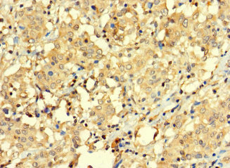 BAGE3 Antibody - Immunohistochemistry of paraffin-embedded human lung cancer using BAGE3 Antibody at dilution of 1:100