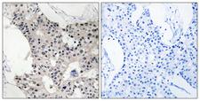 BAGE4 Antibody - Peptide - + Immunohistochemistry analysis of paraffin-embedded human breast carcinoma tissue using BAGE4 antibody.