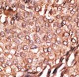 BAIAP2 / IRSP53 Antibody - Formalin-fixed and paraffin-embedded human cancer tissue reacted with the primary antibody, which was peroxidase-conjugated to the secondary antibody, followed by AEC staining. This data demonstrates the use of this antibody for immunohistochemistry; clinical relevance has not been evaluated. BC = breast carcinoma; HC = hepatocarcinoma.
