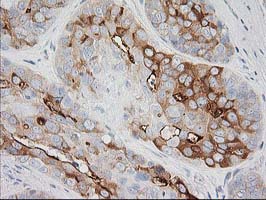 BAIAP2 / IRSP53 Antibody - IHC of paraffin-embedded Adenocarcinoma of Human breast tissue using anti-BAIAP2 mouse monoclonal antibody.
