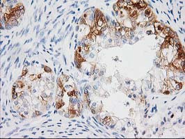 BAIAP2 / IRSP53 Antibody - IHC of paraffin-embedded Adenocarcinoma of Human ovary tissue using anti-BAIAP2 mouse monoclonal antibody.
