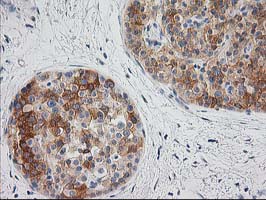 BAIAP2 / IRSP53 Antibody - IHC of paraffin-embedded Carcinoma of Human pancreas tissue using anti-BAIAP2 mouse monoclonal antibody.