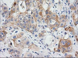 BAIAP2 / IRSP53 Antibody - IHC of paraffin-embedded Carcinoma of Human bladder tissue using anti-BAIAP2 mouse monoclonal antibody.