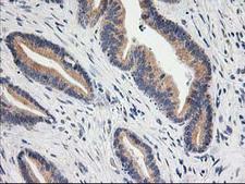 BAIAP2 / IRSP53 Antibody - IHC of paraffin-embedded Adenocarcinoma of Human colon tissue using anti-BAIAP2 mouse monoclonal antibody.