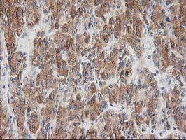 BAIAP2 / IRSP53 Antibody - IHC of paraffin-embedded Carcinoma of Human liver tissue using anti-BAIAP2 mouse monoclonal antibody.