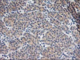 BAIAP2 / IRSP53 Antibody - IHC of paraffin-embedded Carcinoma of Human thyroid tissue using anti-BAIAP2 mouse monoclonal antibody.