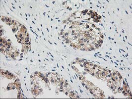 BAIAP2 / IRSP53 Antibody - IHC of paraffin-embedded Adenocarcinoma of Human ovary tissue using anti-BAIAP2 mouse monoclonal antibody.