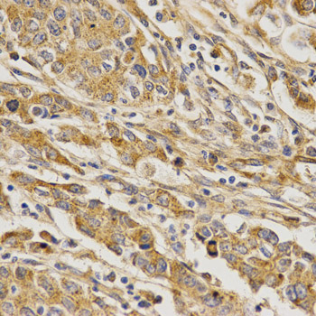 BAIAP2 / IRSP53 Antibody - Immunohistochemistry of paraffin-embedded human stomach cancer using BAIAP2 antibody at dilution of 1:200 (x400 lens).