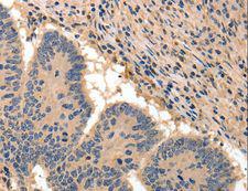 BAIAP2 / IRSP53 Antibody - Immunohistochemistry of paraffin-embedded Human colon cancer using BAIAP2 Polyclonal Antibody at dilution of 1:50.