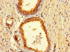 BAIAP2L1 Antibody - Immunohistochemistry of paraffin-embedded human prostate cancer using BAIAP2L1 Antibody at dilution of 1:100