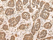 BAIAP2L1 Antibody - Immunohistochemistry of paraffin-embedded Human esophagus cancer tissue  using BAIAP2L1 Polyclonal Antibody at dilution of 1:30(×200)