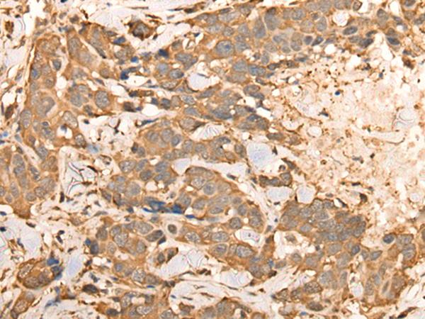 BAIAP2L1 Antibody - Immunohistochemistry of paraffin-embedded Human thyroid cancer tissue  using BAIAP2L1 Polyclonal Antibody at dilution of 1:30(×200)