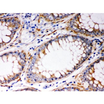 BAK1 / BAK Antibody - BAK antibody IHC-paraffin. IHC(P): Human Intestinal Cancer Tissue.