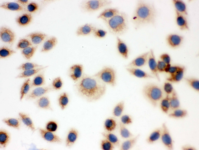 BAK1 / BAK Antibody - IHC analysis of BAK using anti-BAK antibody. BAK was detected in immunocytochemical section of SMMC-7721 cell. Heat mediated antigen retrieval was performed in citrate buffer (pH6, epitope retrieval solution) for 20 mins. The tissue section was blocked with 10% goat serum. The tissue section was then incubated with 1µg/ml rabbit anti-BAK Antibody overnight at 4°C. Biotinylated goat anti-rabbit IgG was used as secondary antibody and incubated for 30 minutes at 37°C. The tissue section was developed using Strepavidin-Biotin-Complex (SABC) with DAB as the chromogen.