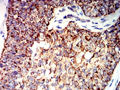 BAK1 / BAK Antibody - Immunohistochemical analysis of paraffin-embedded bladder cancer tissues using BAK1 mouse mAb with DAB staining.