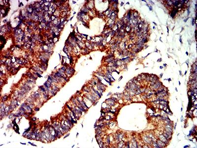 BAK1 / BAK Antibody - Immunohistochemical analysis of paraffin-embedded rectum cancer tissues using BAK1 mouse mAb with DAB staining.