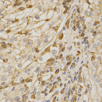 BAK1 / BAK Antibody - Immunohistochemistry of paraffin-embedded human kidney cancer tissue.