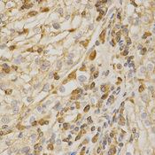 BAK1 / BAK Antibody - Immunohistochemistry of paraffin-embedded human kidney cancer tissue.