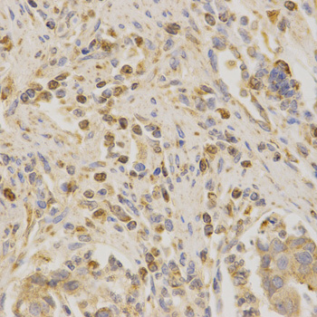 BAK1 / BAK Antibody - Immunohistochemistry of paraffin-embedded human stomach cancer tissue.