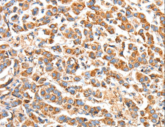 BAK1 / BAK Antibody - Immunohistochemistry of paraffin-embedded Human breast cancer using BAK1 Polyclonal Antibody at dilution of 1:50.