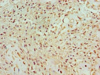 BANP Antibody - Immunohistochemistry of paraffin-embedded human breast cancer using antibody at 1:100 dilution.