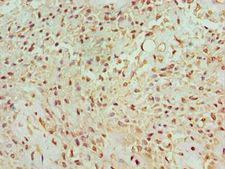 BANP Antibody - Immunohistochemistry of paraffin-embedded human breast cancer using antibody at 1:100 dilution.