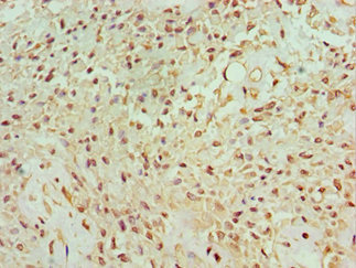 BANP Antibody - Immunohistochemistry of paraffin-embedded human breast cancer using BANP Antibody at dilution of 1:100
