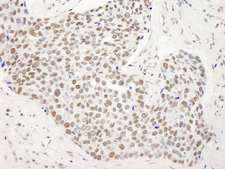 BANP Antibody - Detection of Human SMAR1/BANP by Immunohistochemistry. Sample: FFPE section of human breast tumor. Antibody: Affinity purified rabbit anti-SMAR1/BANP used at a dilution of 1:250.