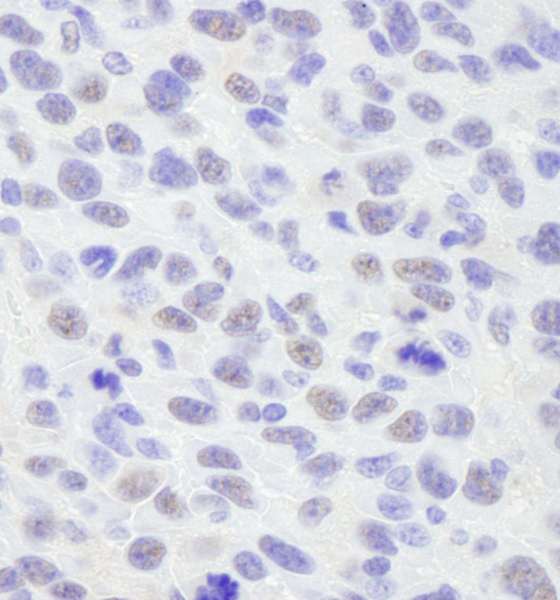 BANP Antibody - Detection of Mouse SMAR1/BANP by Immunohistochemistry. Sample: FFPE section of mouse squamous cell carcinoma. Antibody: Affinity purified rabbit anti-SMAR1/BANP used at a dilution of 1:250.