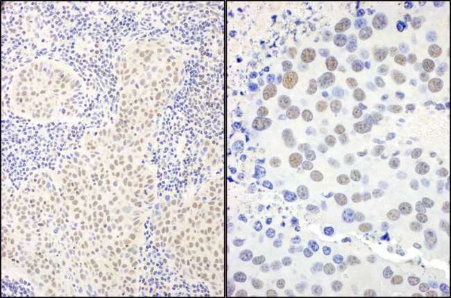 BANP Antibody - Detection of Human and Mouse by Immunohistochemistry. Sample: FFPE sections of human lung carcinoma (left) and mouse renal cell carcinoma (right). Antibody: Affinity purified rabbit anti- used at a dilution of 1:5000 (0.2 Detection: DAB.