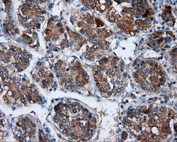 BAP / SIL1 Antibody - IHC of paraffin-embedded Carcinoma of liver tissue using anti-SIL1 mouse monoclonal antibody. (Dilution 1:50).