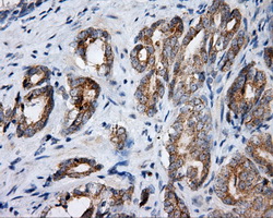 BAP / SIL1 Antibody - IHC of paraffin-embedded Carcinoma of prostate tissue using anti-SIL1 mouse monoclonal antibody. (Dilution 1:50).