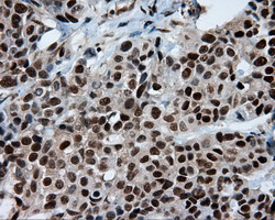 BAP / SIL1 Antibody - Immunohistochemical staining of paraffin-embedded Adenocarcinoma of breast tissue using anti-SIL1 mouse monoclonal antibody. (Dilution 1:50).