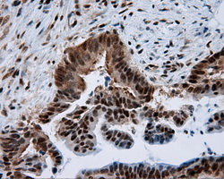 BAP / SIL1 Antibody - Immunohistochemical staining of paraffin-embedded Adenocarcinoma of colon tissue using anti-SIL1 mouse monoclonal antibody. (Dilution 1:50).