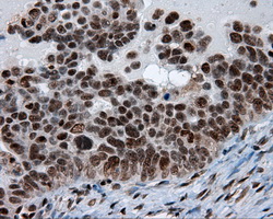 BAP / SIL1 Antibody - Immunohistochemical staining of paraffin-embedded Adenocarcinoma of ovary tissue using anti-SIL1 mouse monoclonal antibody. (Dilution 1:50).