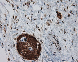 BAP / SIL1 Antibody - Immunohistochemical staining of paraffin-embedded Carcinoma of pancreas tissue using anti-SIL1 mouse monoclonal antibody. (Dilution 1:50).