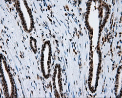 BAP / SIL1 Antibody - Immunohistochemical staining of paraffin-embedded Carcinoma of prostate tissue using anti-SIL1 mouse monoclonal antibody. (Dilution 1:50).