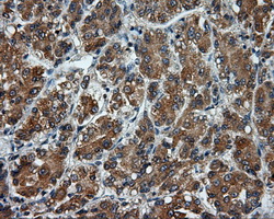 BAP / SIL1 Antibody - Immunohistochemical staining of paraffin-embedded Carcinoma of liver tissue using anti-SIL1 mouse monoclonal antibody. (Dilution 1:50).